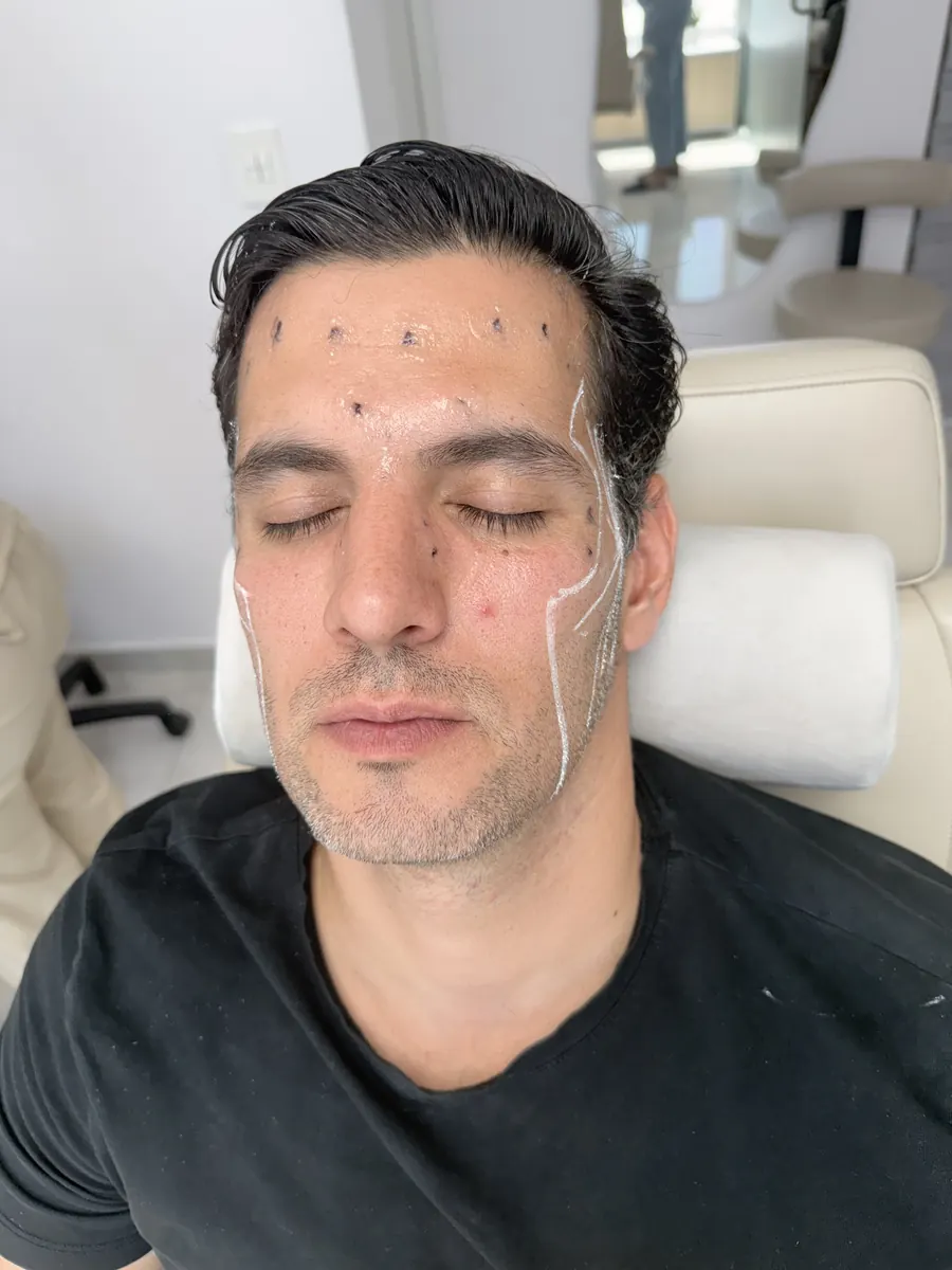 Marcaje facial previo a la aplicación de Sculptra